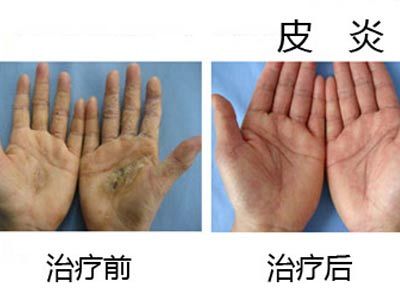 新桥医院皮肤科皮炎病康复案例