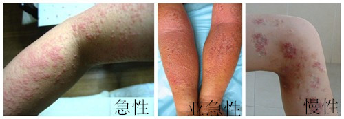 新桥医院皮肤科湿疹康复案例